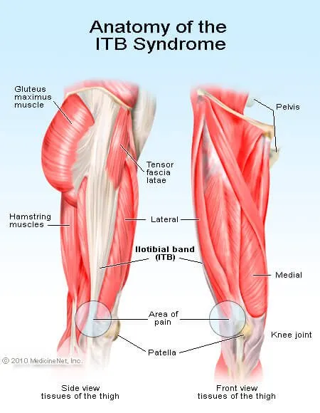 itb-syndrome.jpg