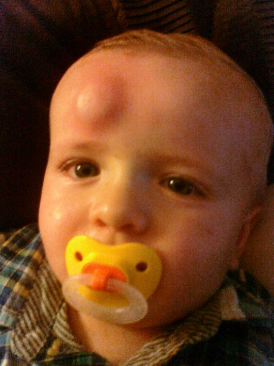 ethans+booboo.jpg