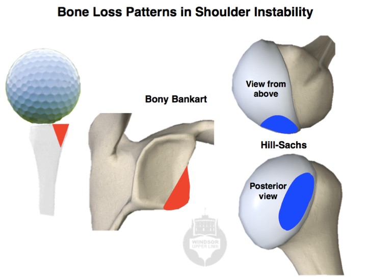 shoulderdislocation3.jpg